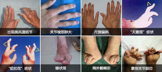郑州痛风风湿病医院类风湿可造成手指、脚趾等多处关节畸形.jpg