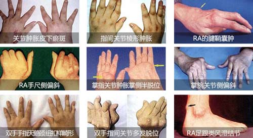 郑州痛风风湿病医院类风湿可造成关节畸形.jpg